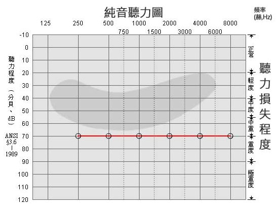 三分钟教您看懂听力测试结果-听力图(图2)