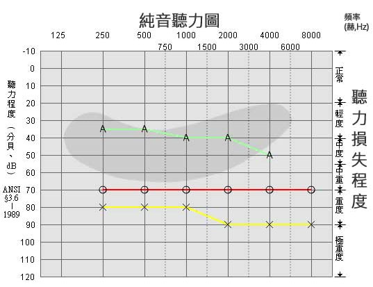 三分钟教您看懂听力测试结果-听力图(图5)
